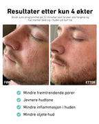 LED-lysmaske til ansikt mot akne, rynker og pigmentflekker