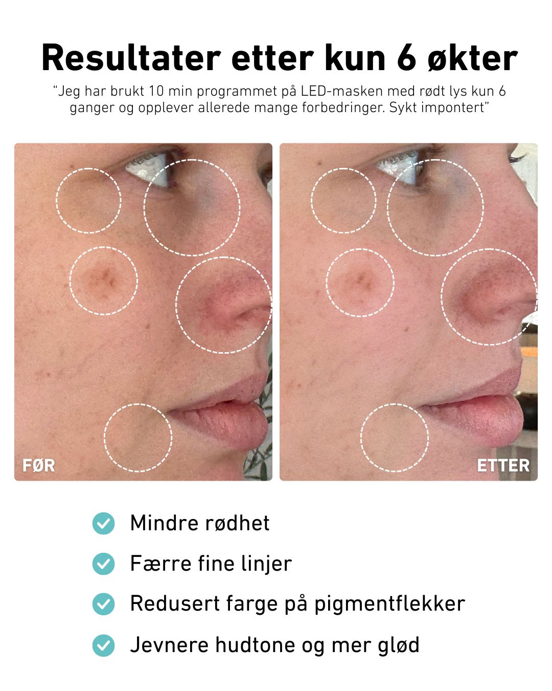 LED-lysmaske ansikt mot akne, rynker og pigmentflekker