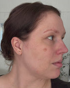 LED-lysmaske til ansikt mot akne, rynker og pigmentflekker